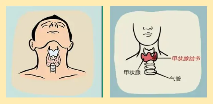 1666682051118838.jpg 杭州结节中医:甲状腺结节会造成的危害有哪些?